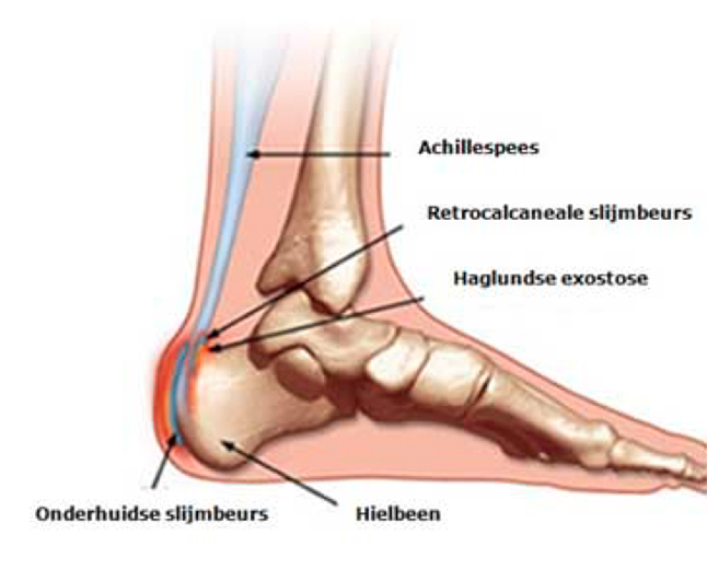 Stekende pijn aan de achterkant van de hiel Stekende pijn aan de achterkant van de hiel